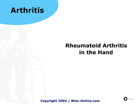 Rheumatoid Arthritis in the Hand