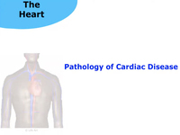 Pathology of Cardiac Disease (Screencast)