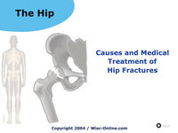 Causes and Medical Treatment of Hip Fractures