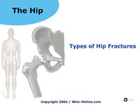 Types of Hip Fractures